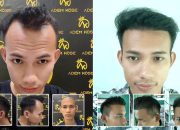 Klinik Tanam Rambut Andalan Seleberiti Tanah Air Kini Hadir di Yogyakarta